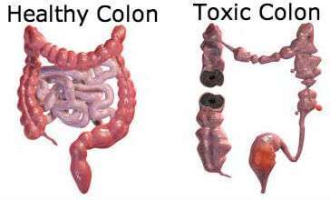 healthy-colon-toxic-colon
