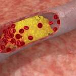 Как да отпушим артериите си и да изчистим лошия холестерол чрез природни продукти