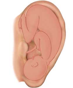 точков масаж су джок акупресура - ембрион ухо